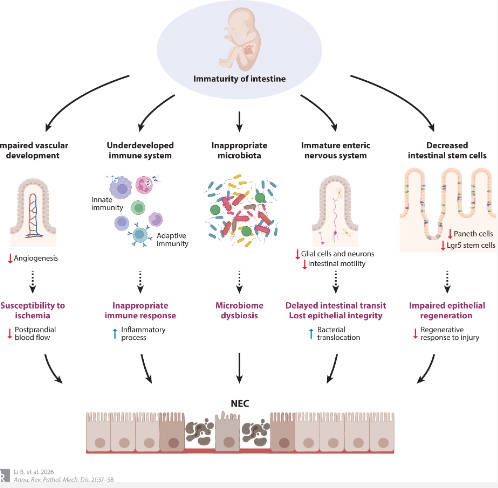 Exploring the Complex Pathophysiology of Necrotizing Enterocolitis in Preterm Neonates